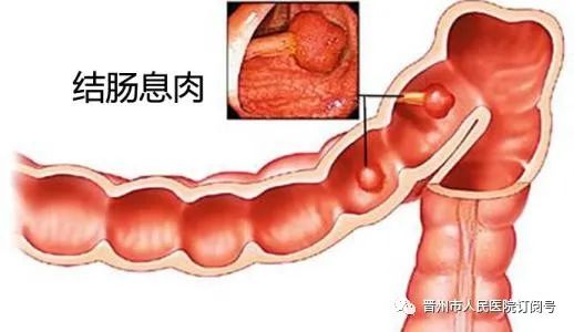 說說你不知道的家族性結腸息肉病