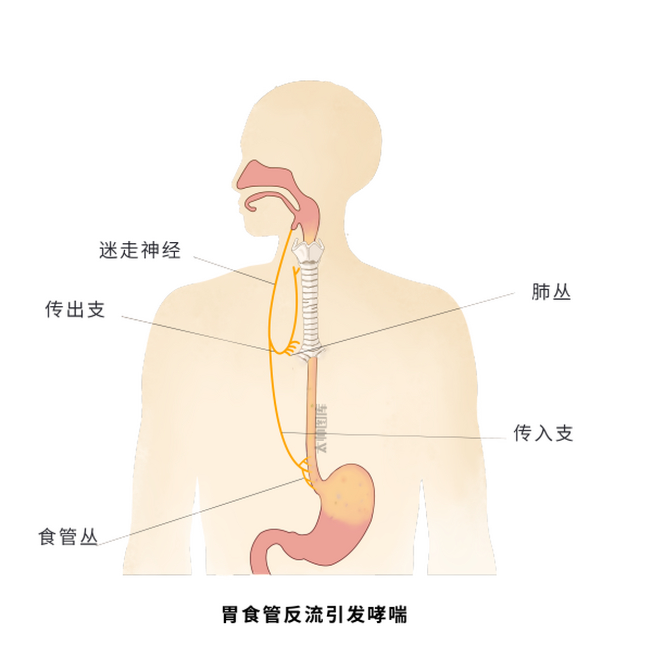 胃食管反流分4期,你看你到了哪一期?