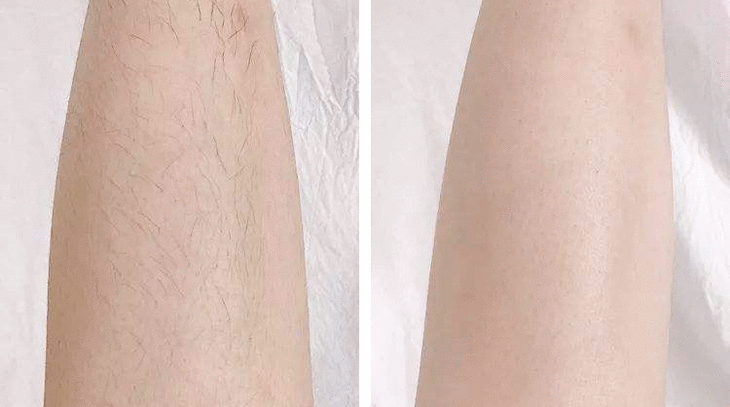 薄皮女生更适合的脱毛方式