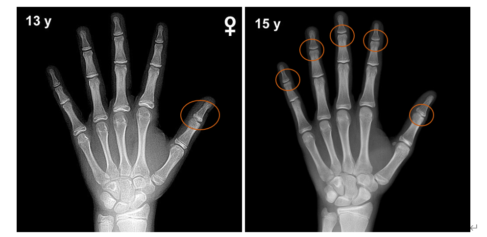 手腕骨骺线闭合图图片