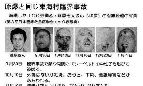 日本核辐射感染者:被医生强行救治83天,每天目睹自己皮肤腐烂