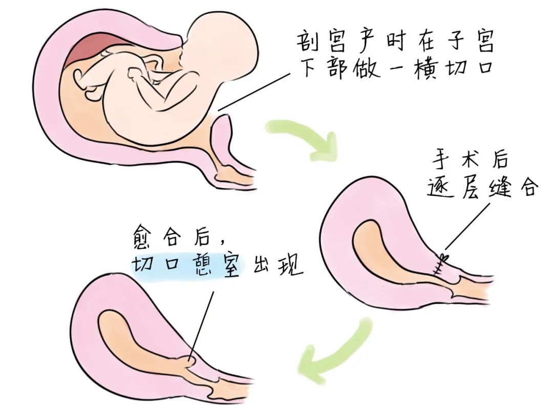 剖宫产切口憩室
