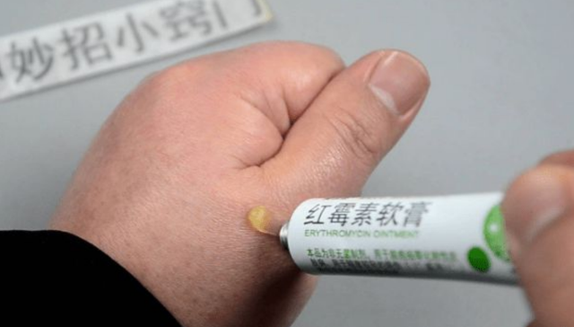 2块钱的红霉素软膏被称为"淡斑专家"?医生说出了答案和用法