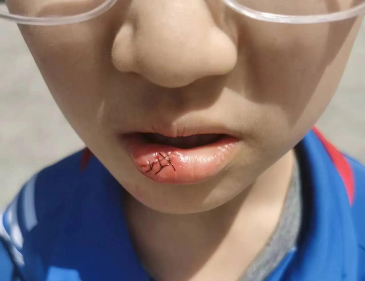 孩子在校受伤嘴唇缝三针,离石区第二小学能否给个说法,教科局呢