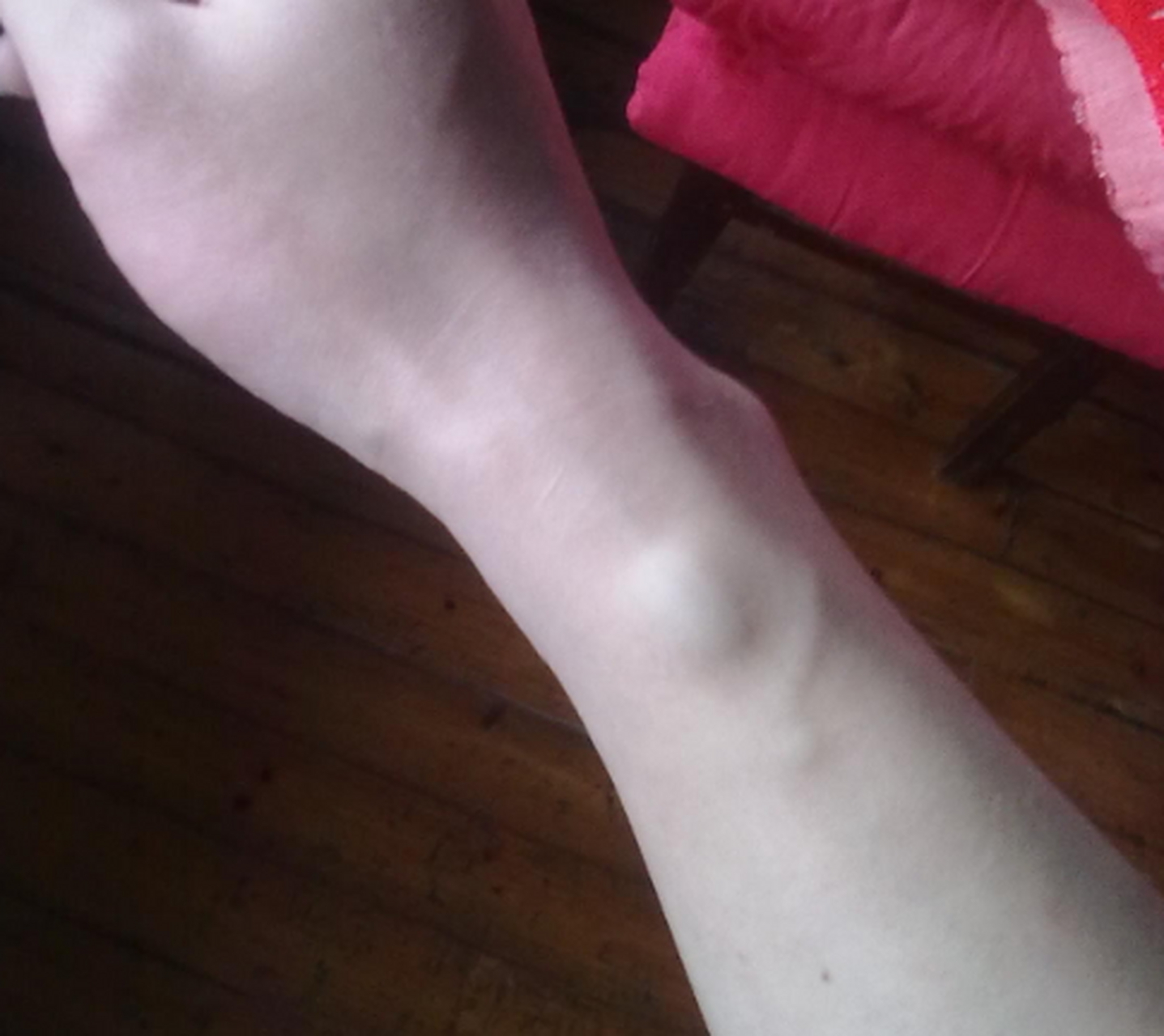 李女士的手腕上长了一个包,到医院之后,医生检查了一下说是腱鞘囊肿