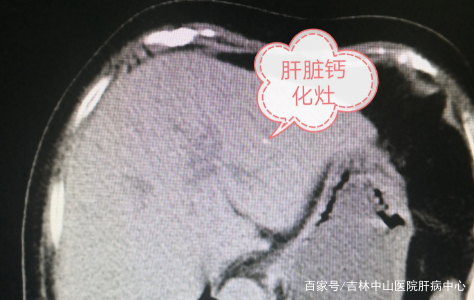 钙化灶什么意思 baijiahao.baidu.com