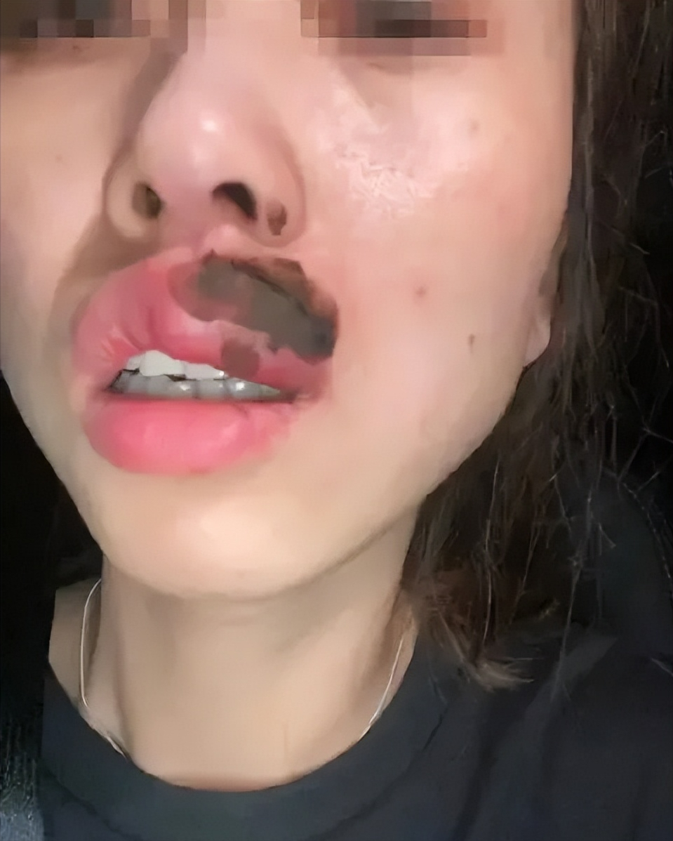 江苏常州一女子睡觉时被"强吻",嘴巴肿胀成香肠,吻得太狠毒