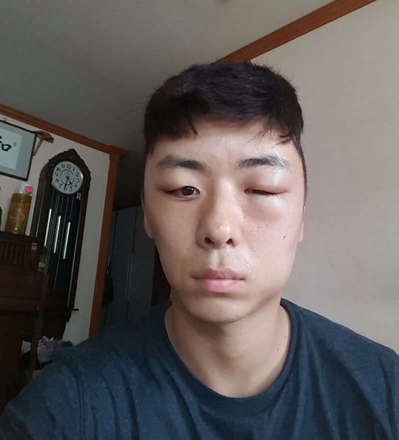 42岁男子检查出尿毒症,需依靠透析活命:后悔年轻时太无知