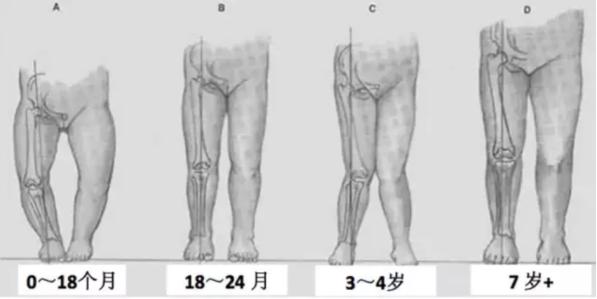 宝宝腿不直是缺钙?你可能一直都想错了