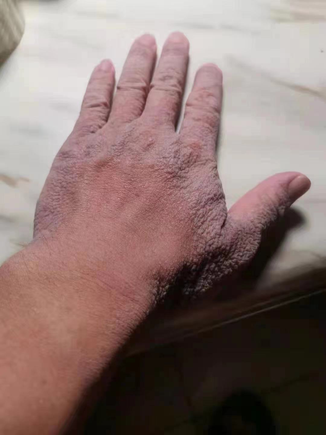 丁虹:手变红变皱像树皮?可能是发生病变了!