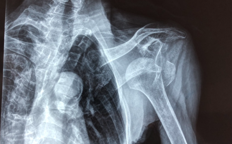 肩锁关节脱位的患者,基本有过外伤,按压局部,有明显的疼痛感