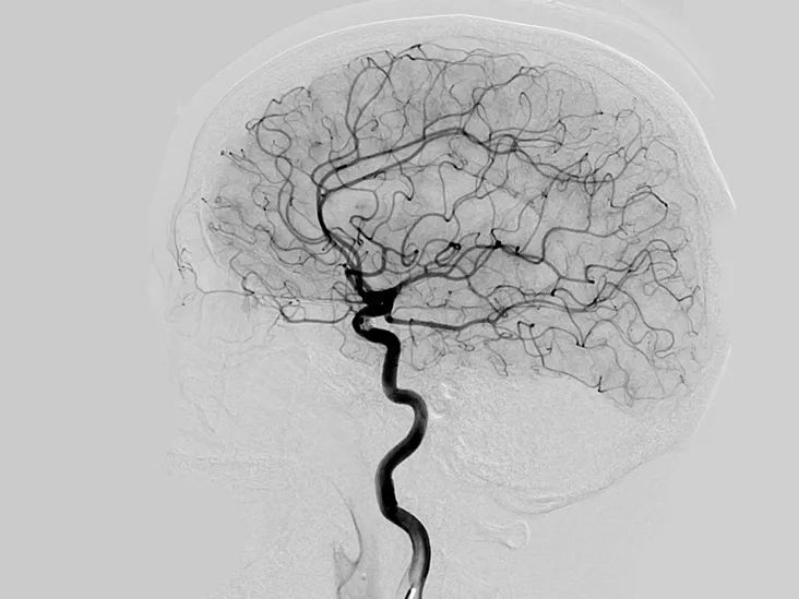 先天性脑血管畸形图片图片