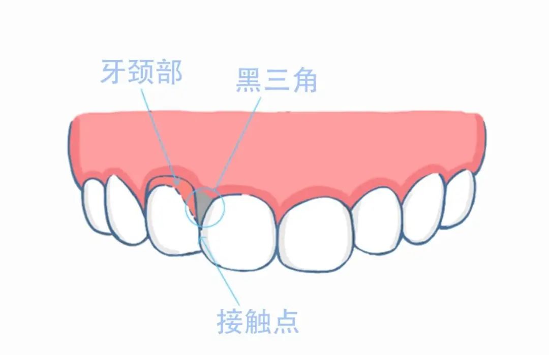 牙齿黑三角怎么形成的?