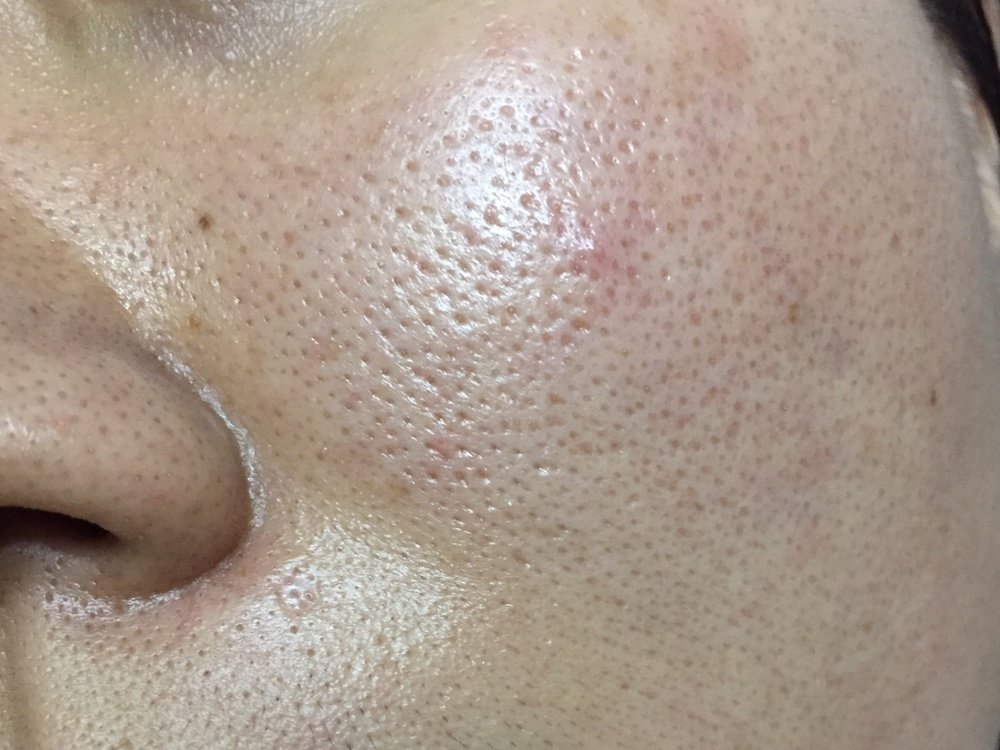 脸上油脂太多面毛孔粗大怎么办 #医美科普挑战赛#   我曾经面临脸上