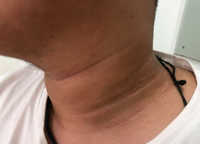 皮肤出现这3个症状,可能是你的血糖偏高,提醒:早预防早治疗