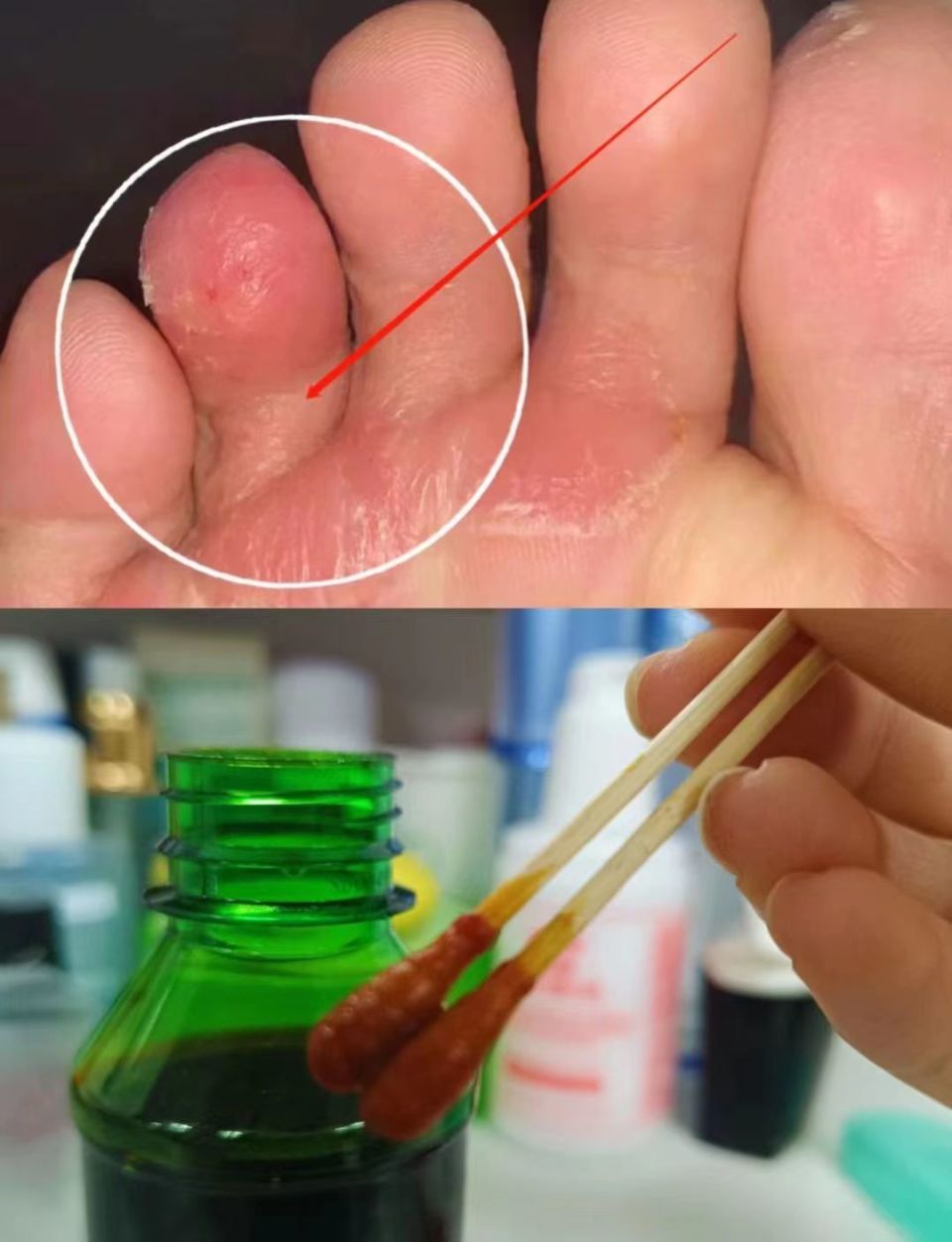 巧用碘伏,顽固脚气彻底除根不复发!