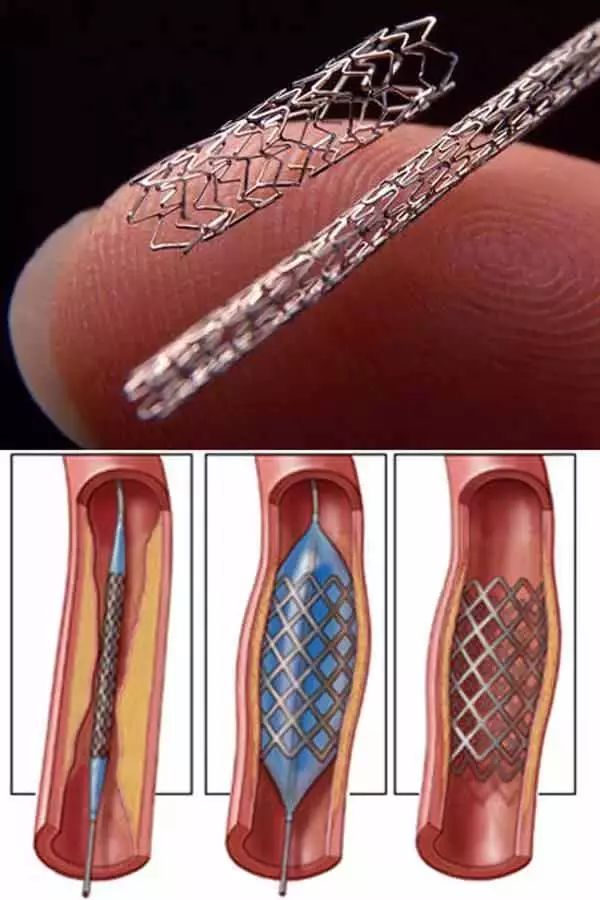 心脏支架的样子图片图片