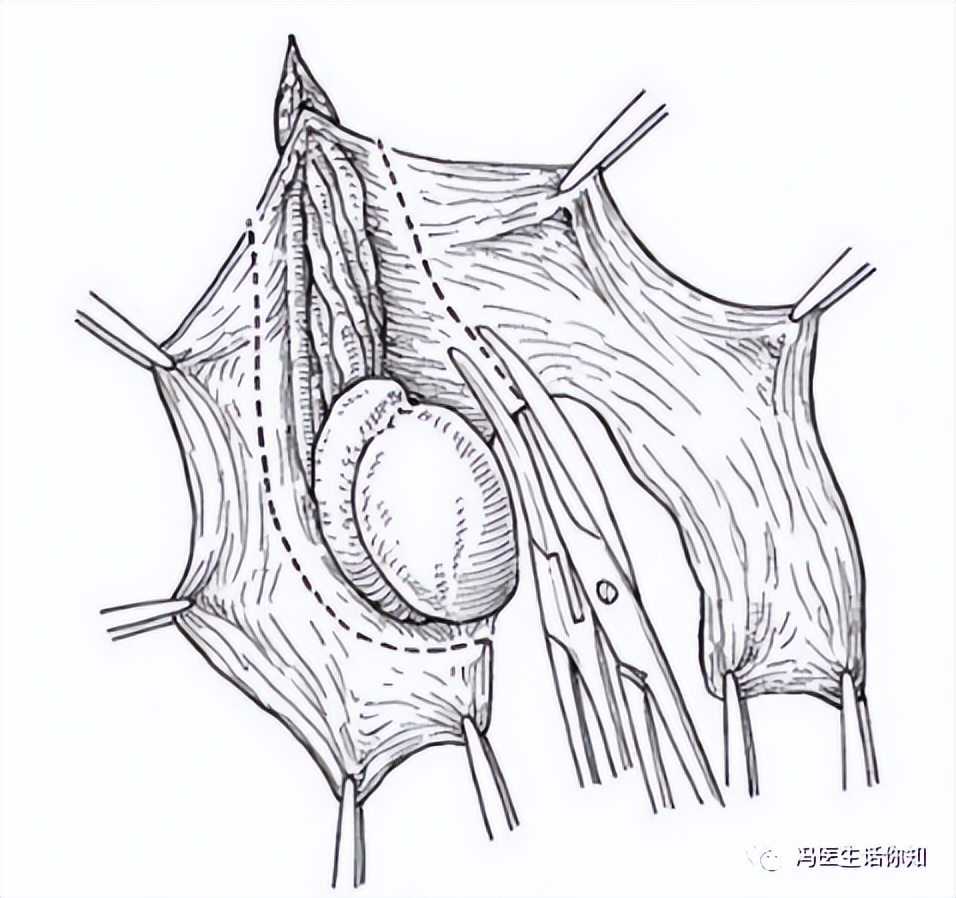 "水疝"是疝气吗?