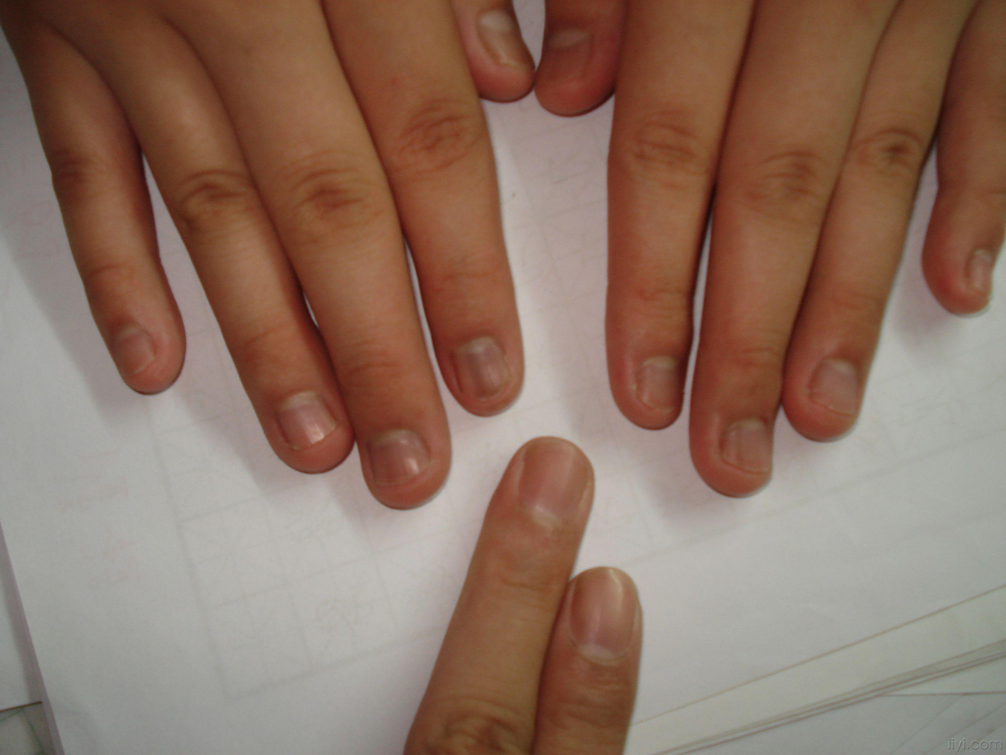 肺病"登门"手先知?若手上有4个"变化",建议给肺部做一下ct