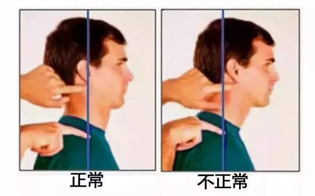 驼背圆肩头前倾,这是种病!
