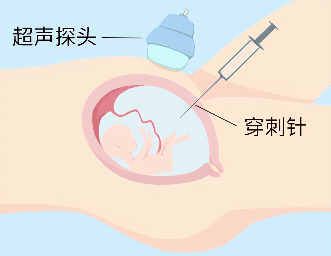 为什么要做羊水穿刺图片