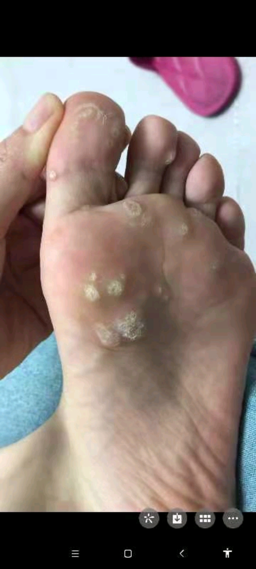足底群发性跖疣处理