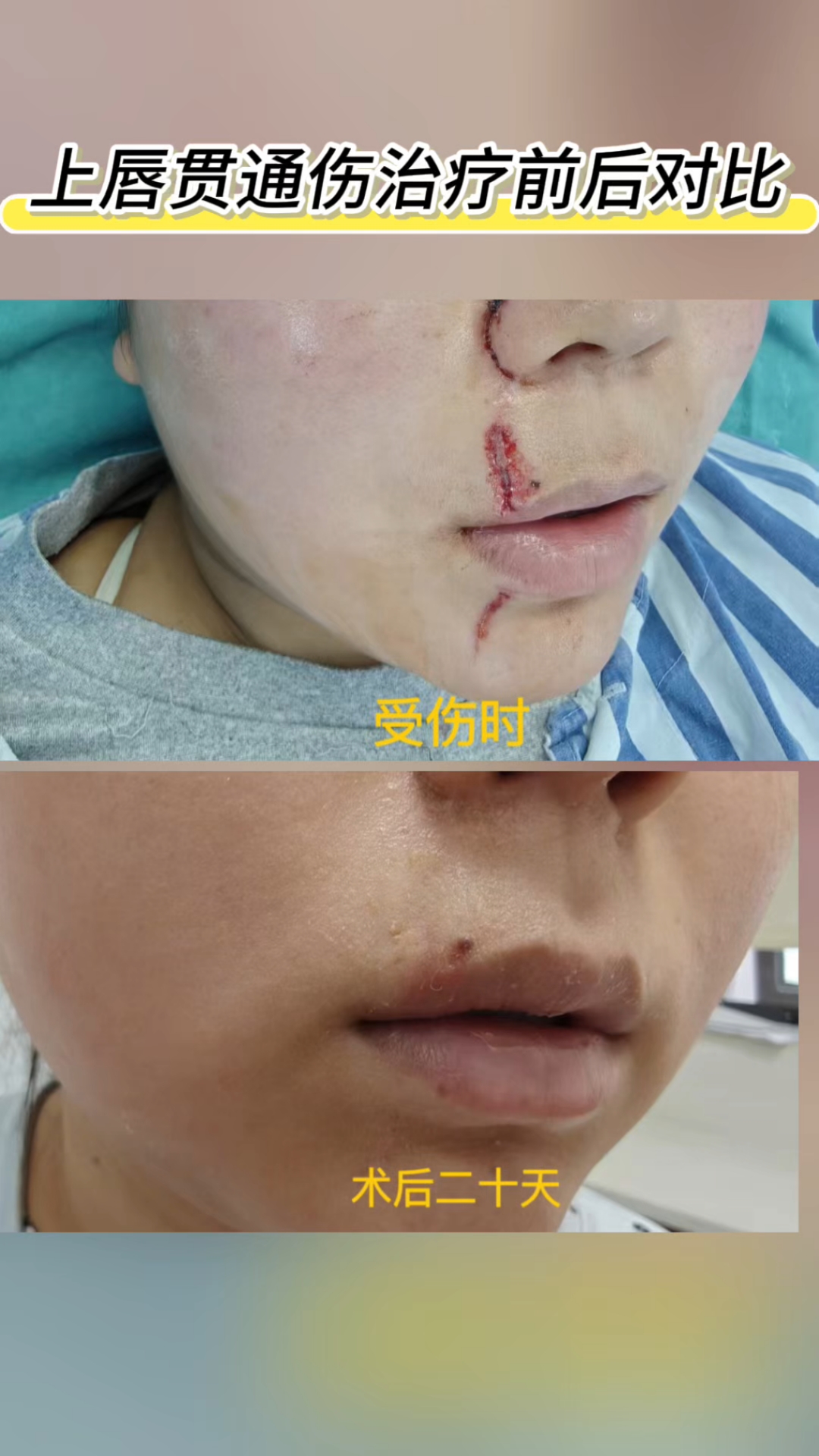 唇贯通伤,精细缝合后前后对比