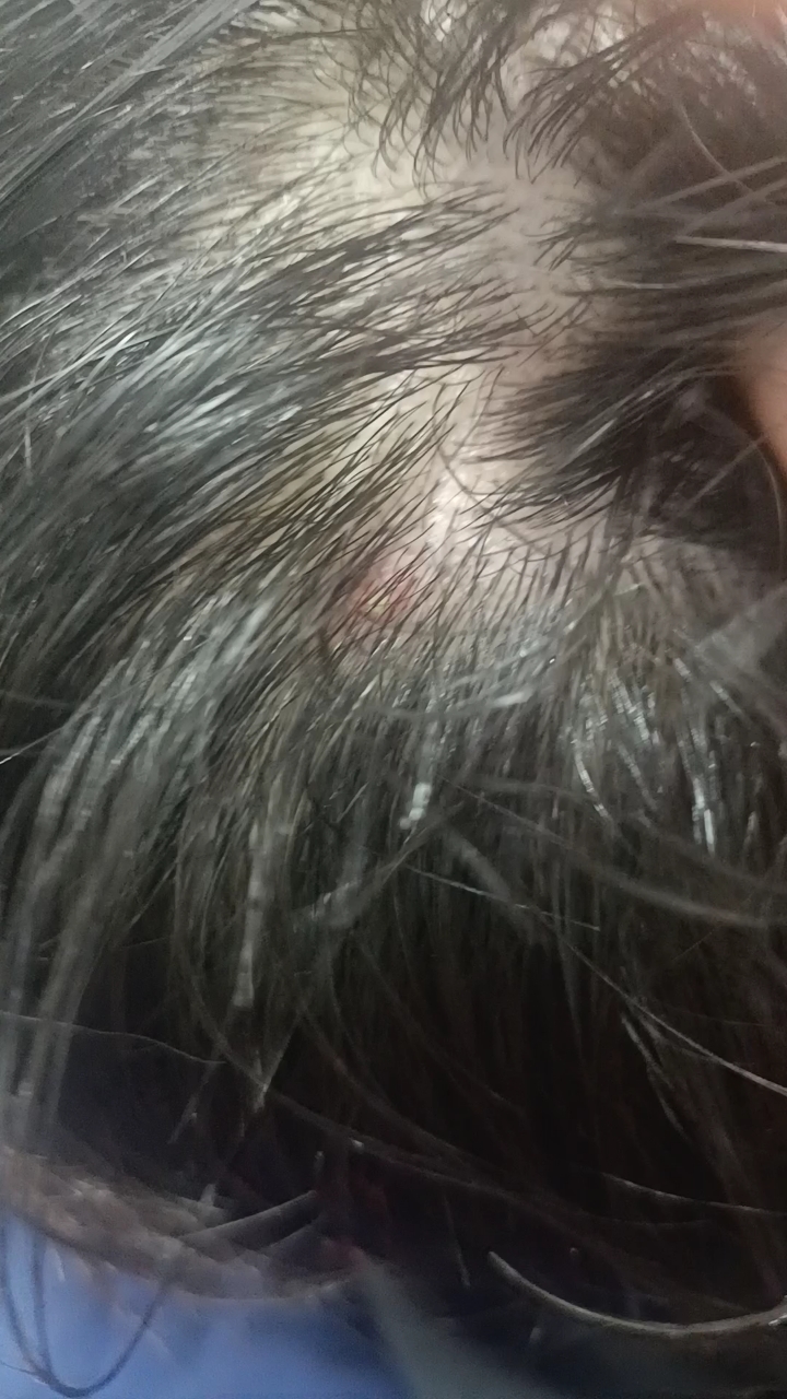 帅哥头上长得毛囊炎, 在店里调理,分享一下