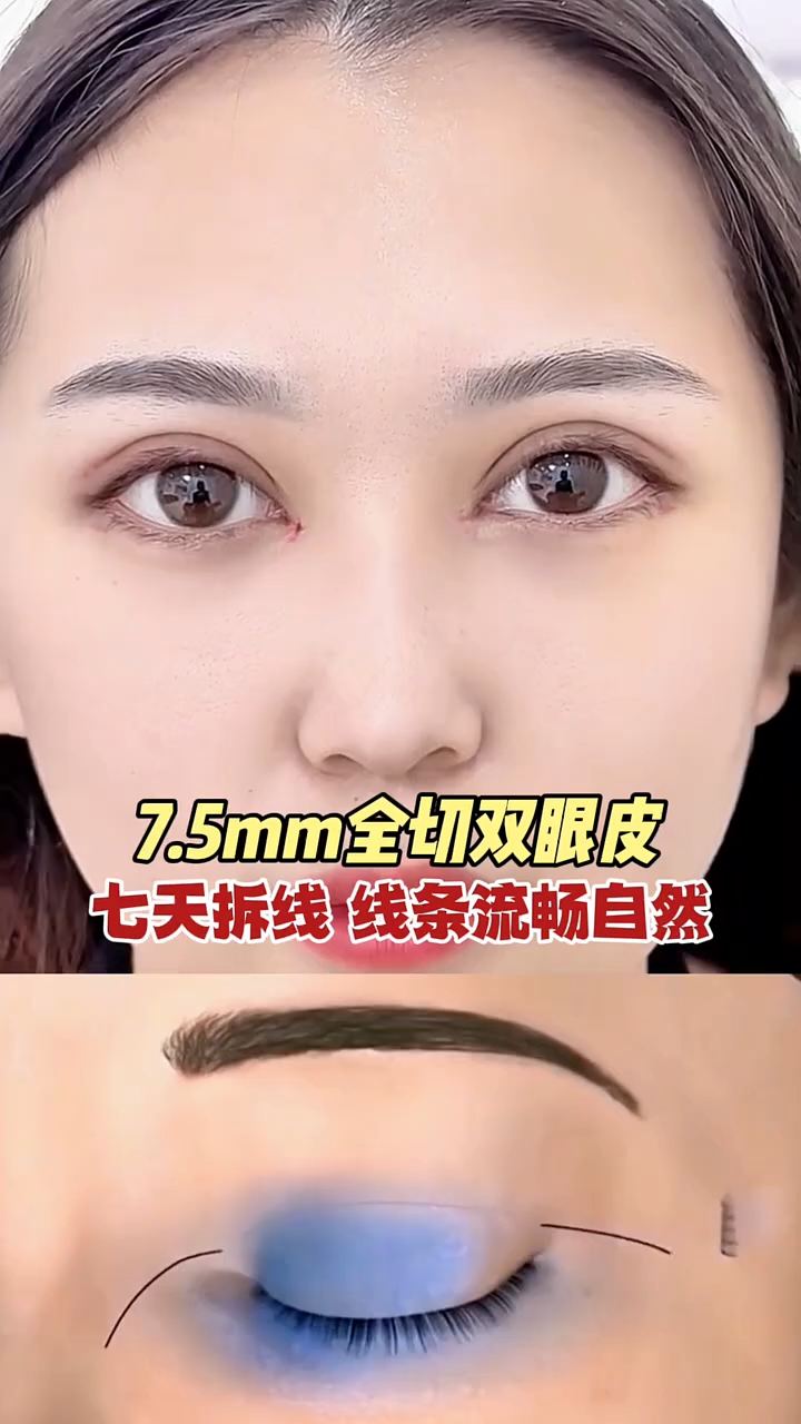 7.5mm全切双眼皮七天拆线