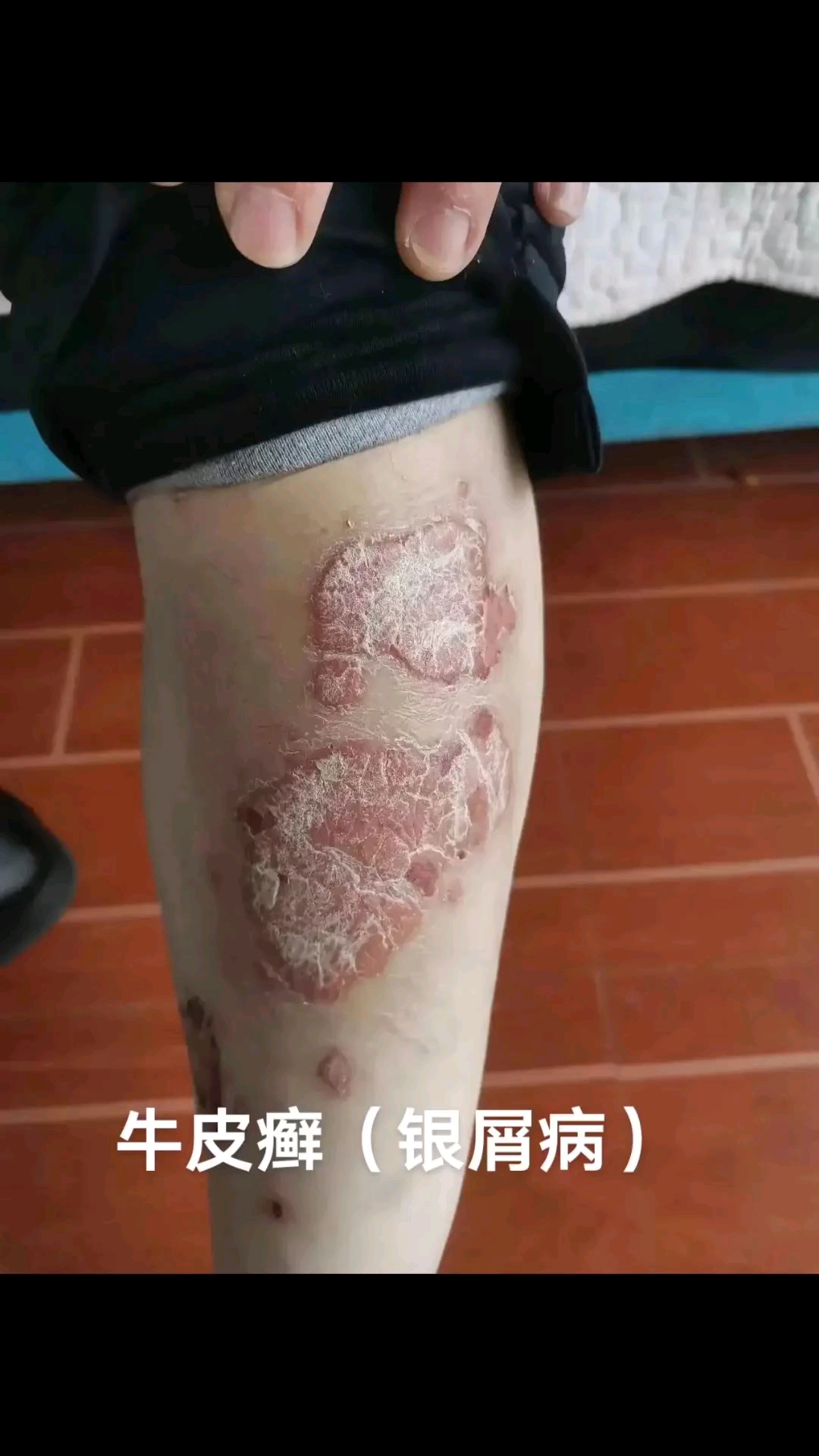 银屑病毁了人生牛皮癣不要放弃坚持就胜利奇迹再现