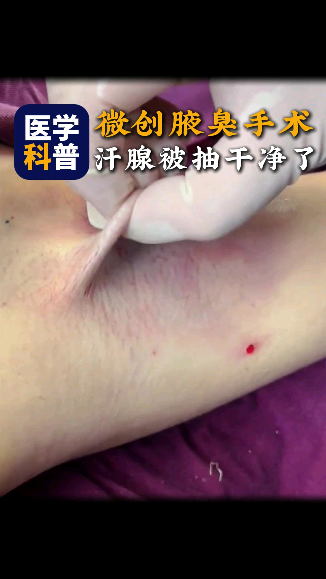 微创腋臭手术,成功切除大汗腺