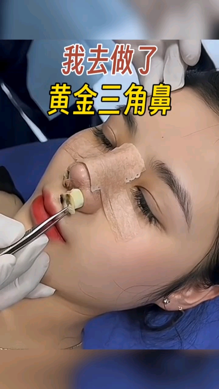 黄金三角鼻案例,上岸了吗