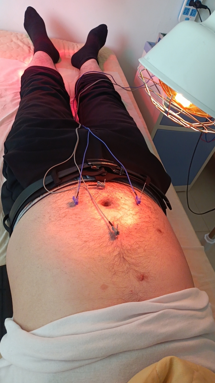 温针灸治疗脾胃虚寒,湿气重,长期大便溏泄,治疗三次后大便正常