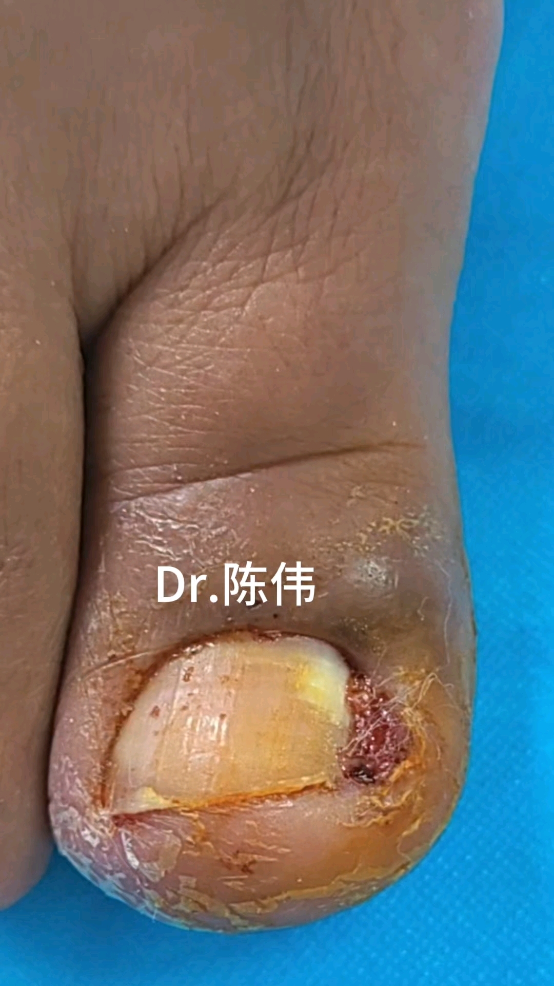 肉芽增生甲沟炎治疗前后对比