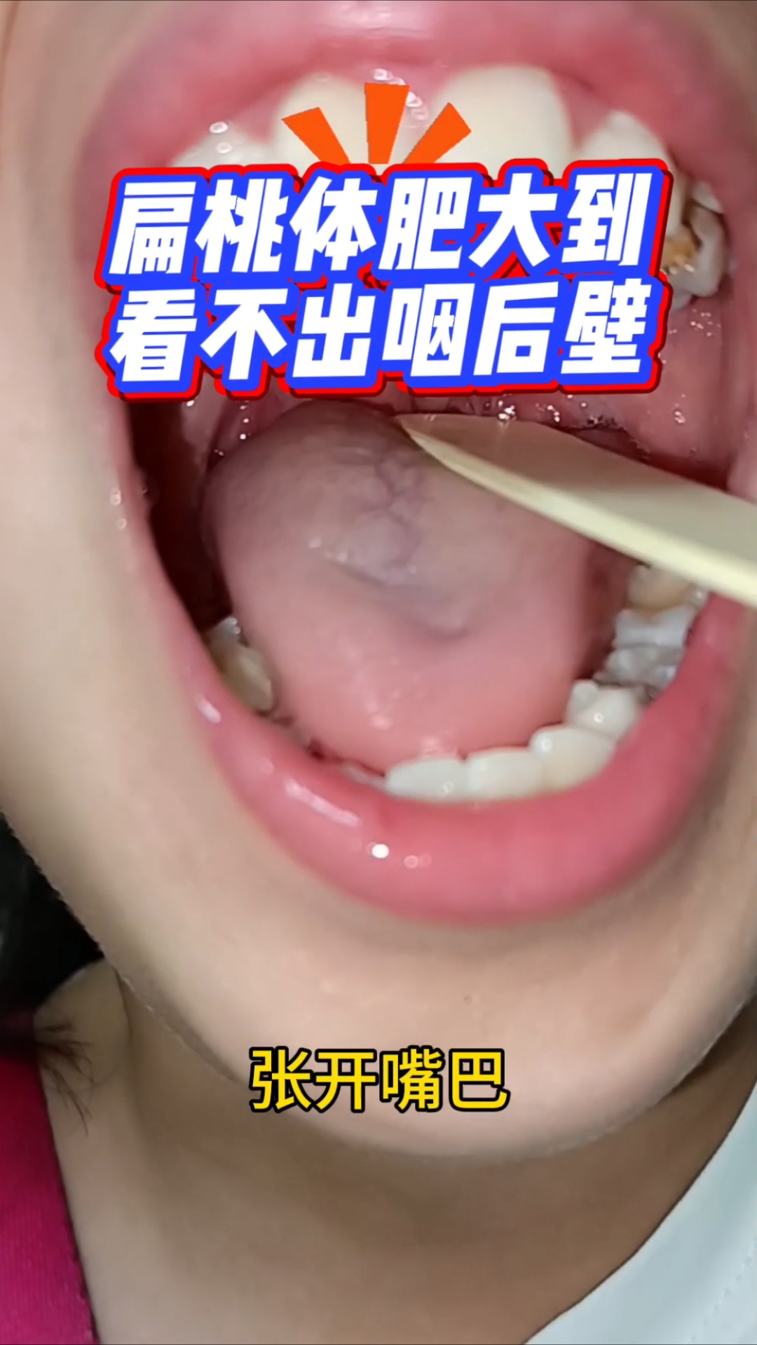 扁桃体太大,看不出咽后壁是什么感觉?影响呼吸和面容!