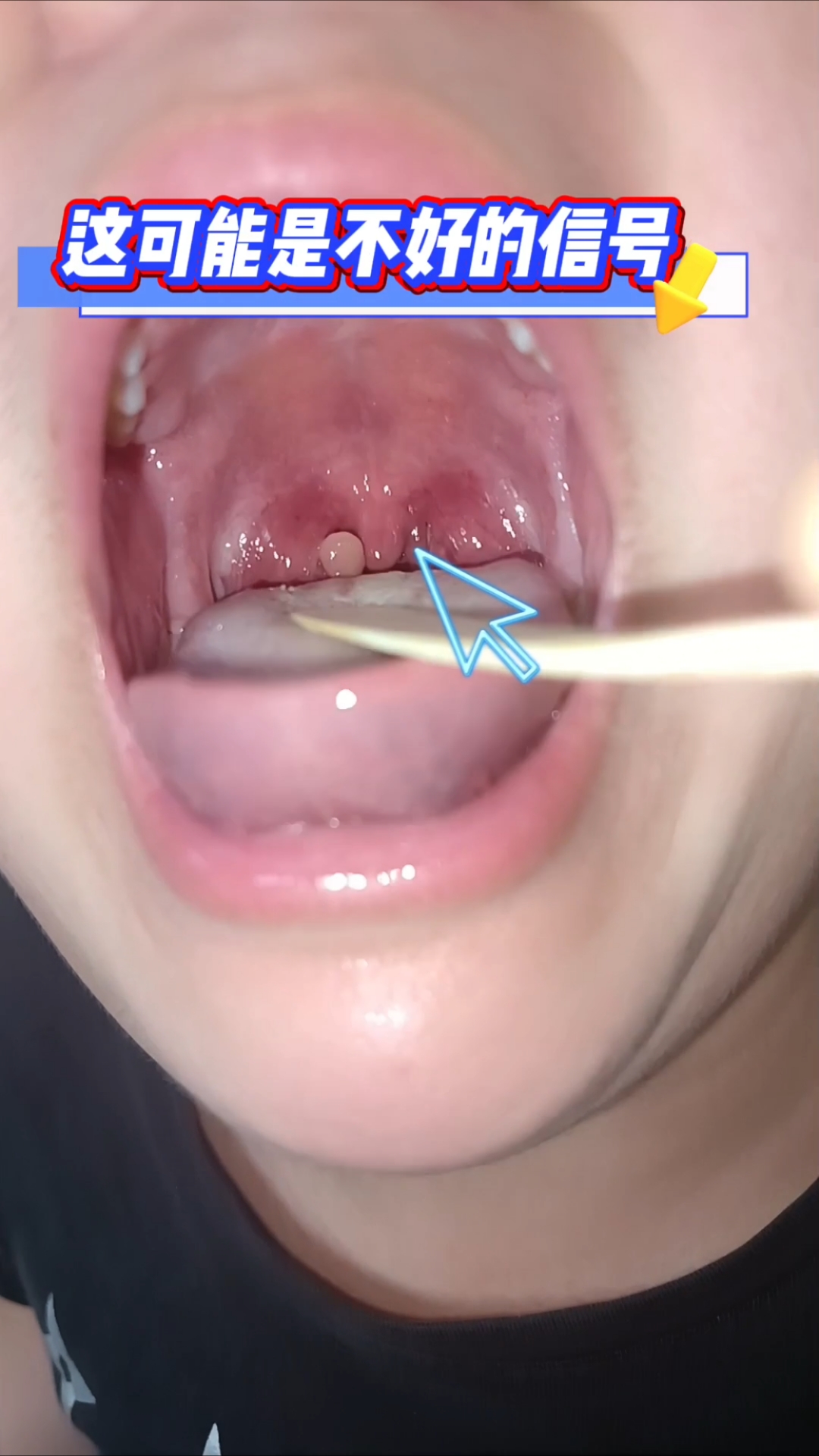 扁桃体新生物,可能是不好的信号,需要及时处理!