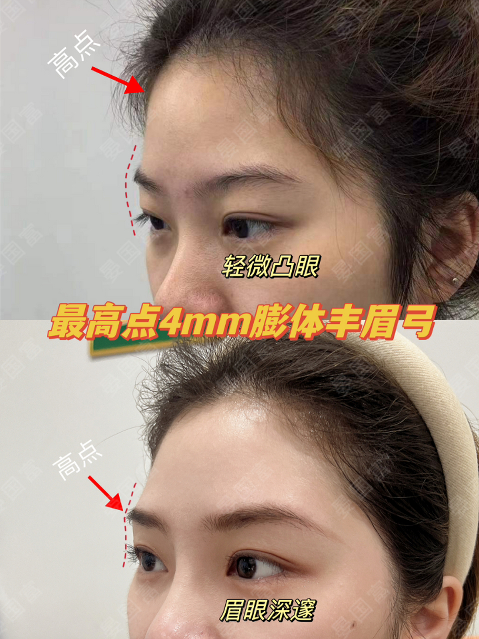 最高点4mm#膨体眉弓#  #脂肪填充# 术后一年半感谢姑娘信任与反馈!