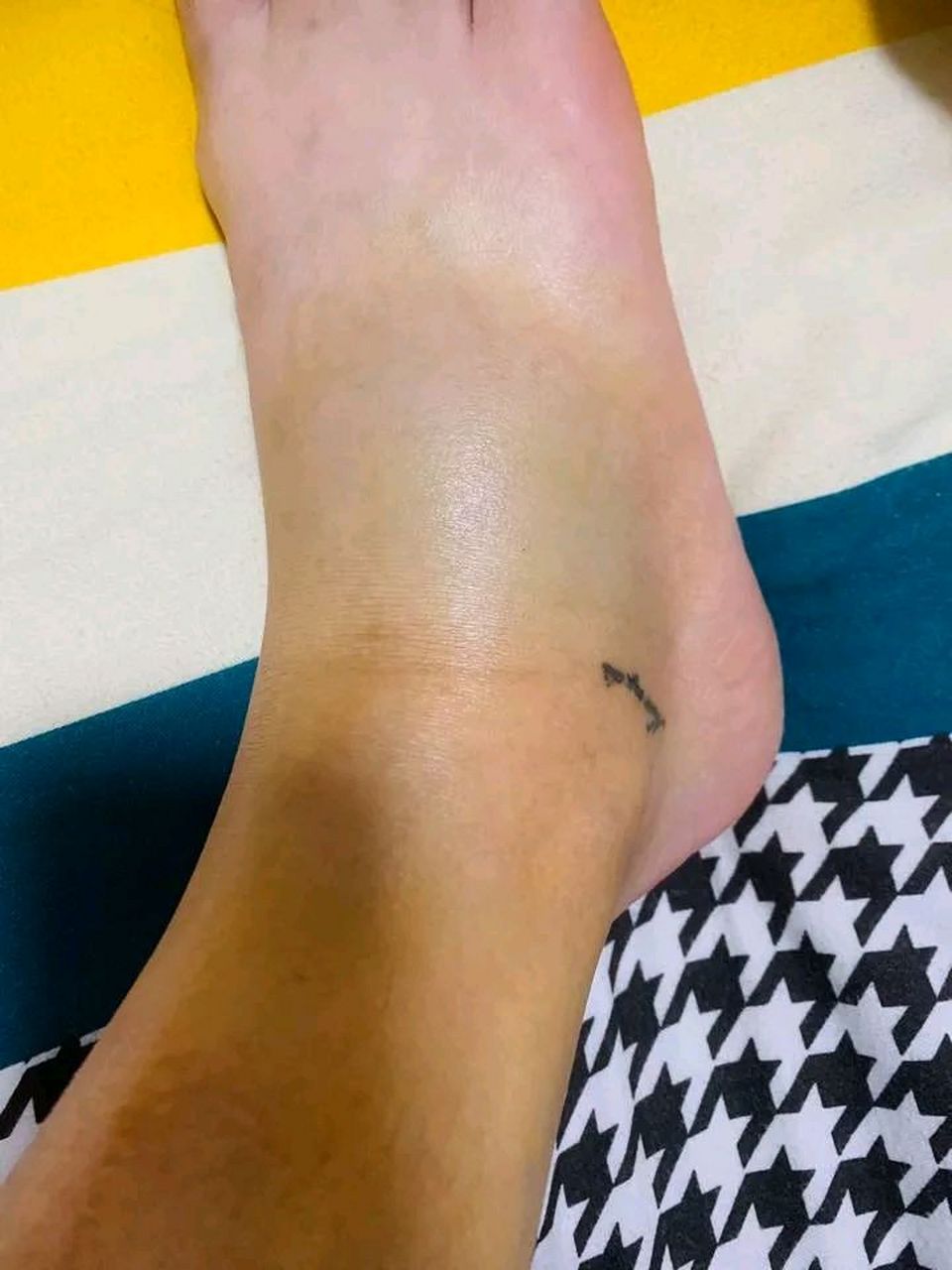 踩空楼梯,崴了脚,肿成猪蹄,倒霉的一天[流泪]