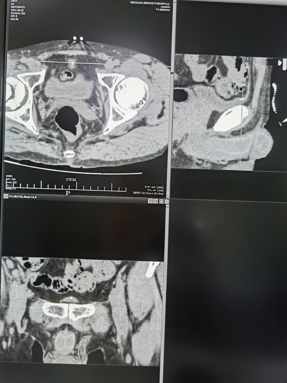膀胱脐尿管结石容易漏诊 工作中经常遇到这样的病例.大家要当心.