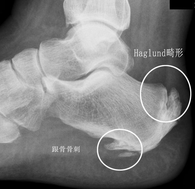 小孩足跟痛是怎么回事?