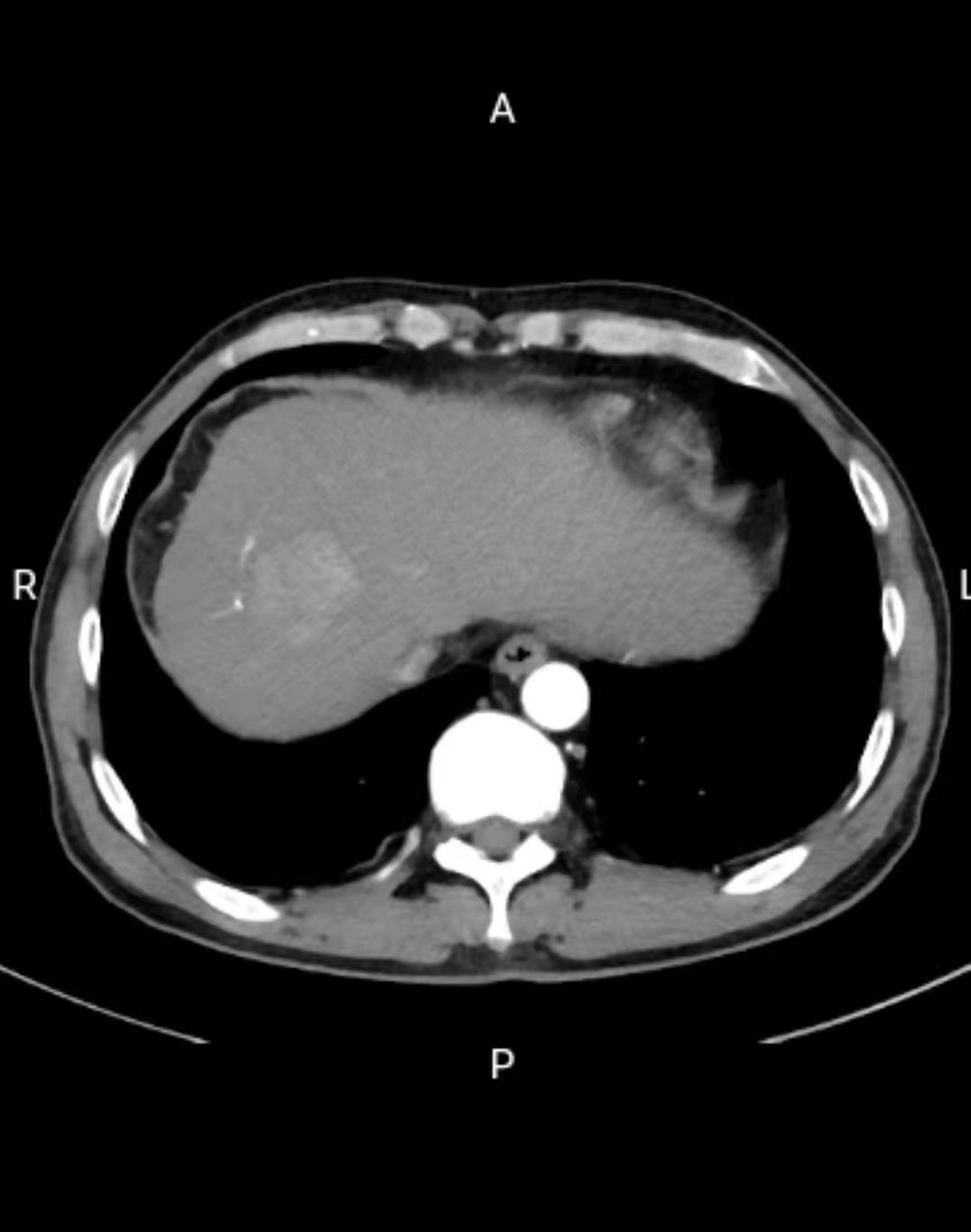 肝肿瘤ct显示图片图片