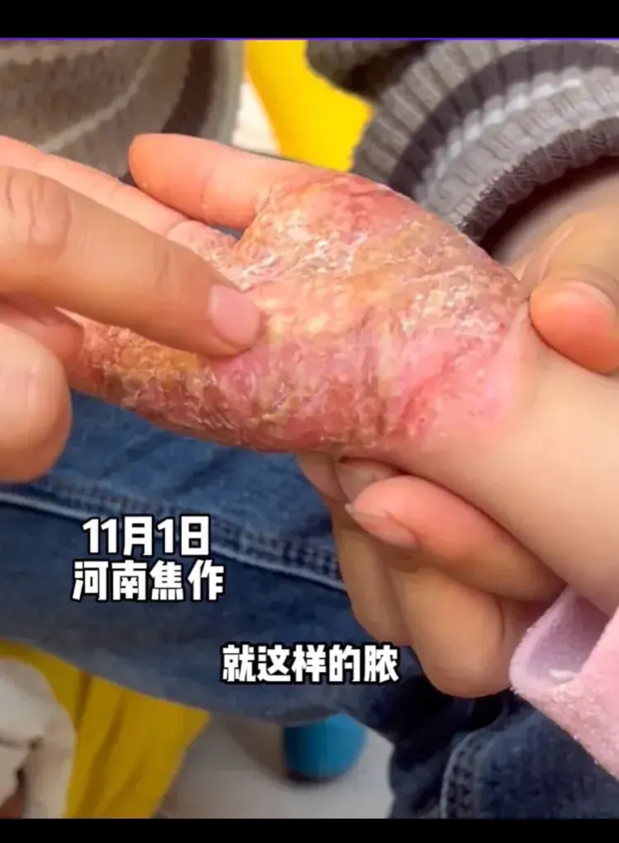 有没有人知道这小女孩手上得的是什么病