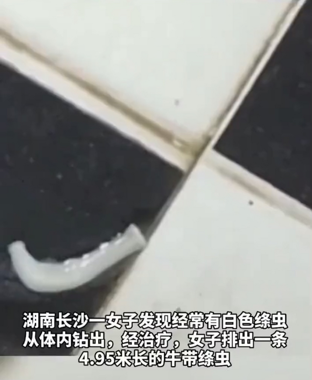 看着好吓人,女子体内排出4.95米长绦虫