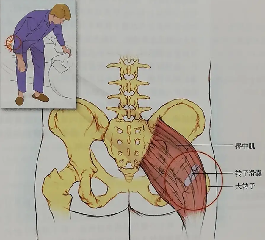 股骨头大转子位置图片