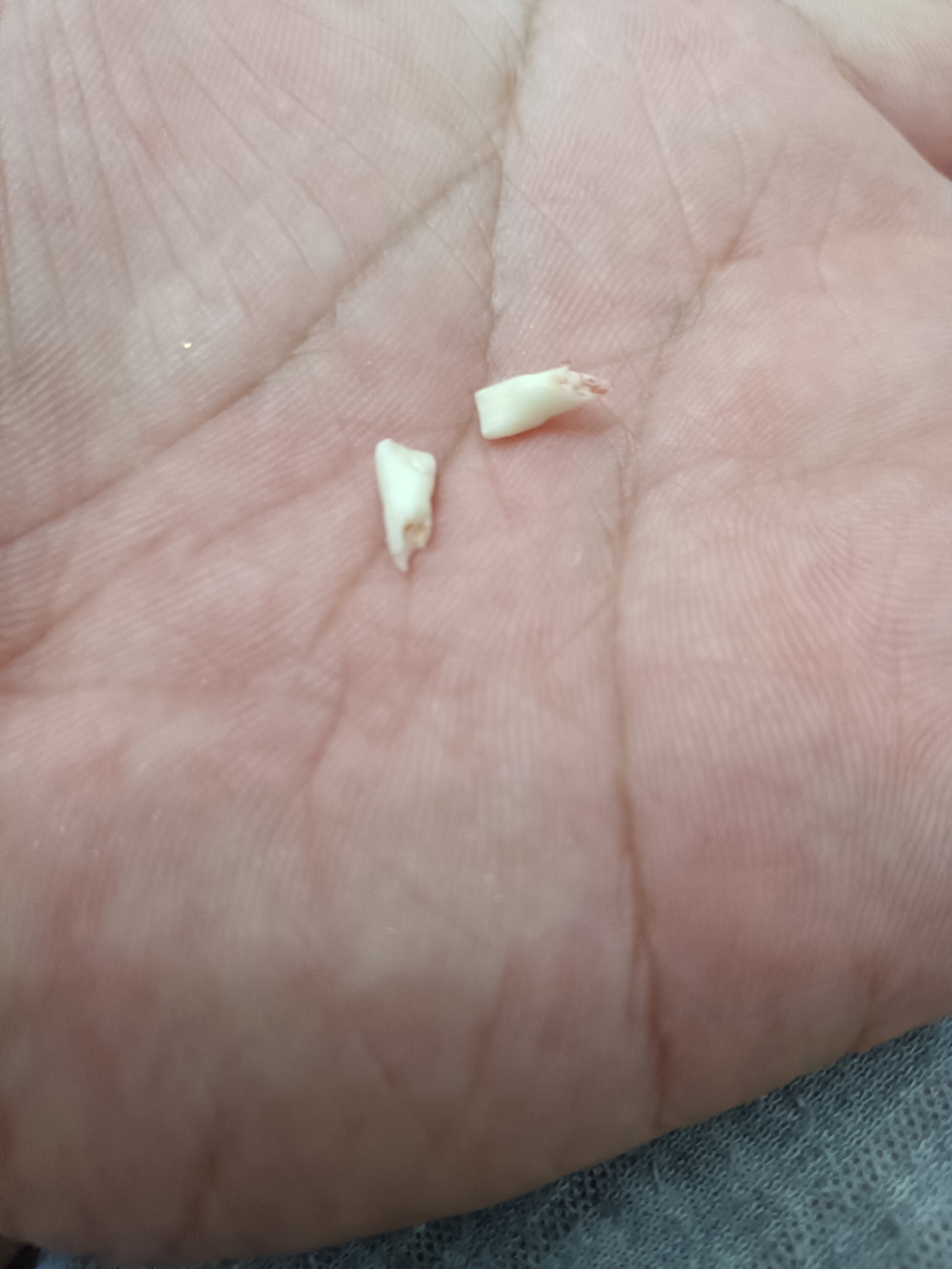 只能把这两颗牙拔掉了!孩子非常勇敢,非常配合,打麻药,拔牙很顺利!