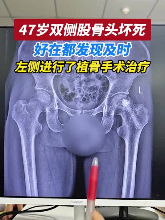 患者双侧股骨头坏死,发现及时