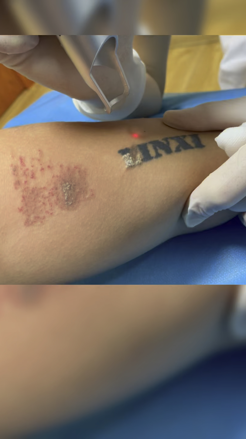 医者仁心,洗纹身#西安肤康中医皮肤病医院#激光#纹身-度小视