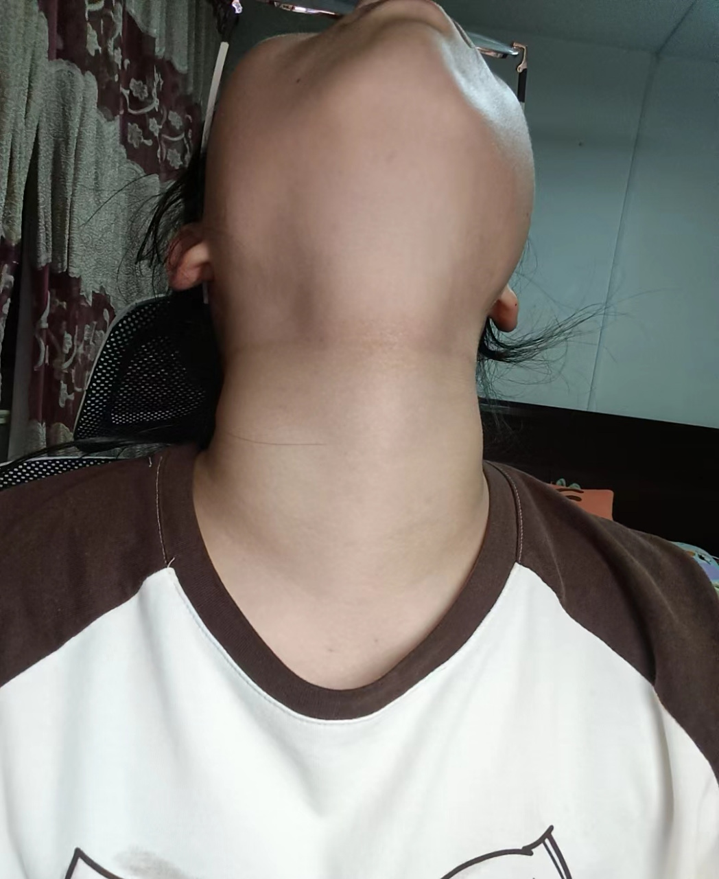 甲状腺结节终于好了,脖子也正常了,感觉自己美美哒!