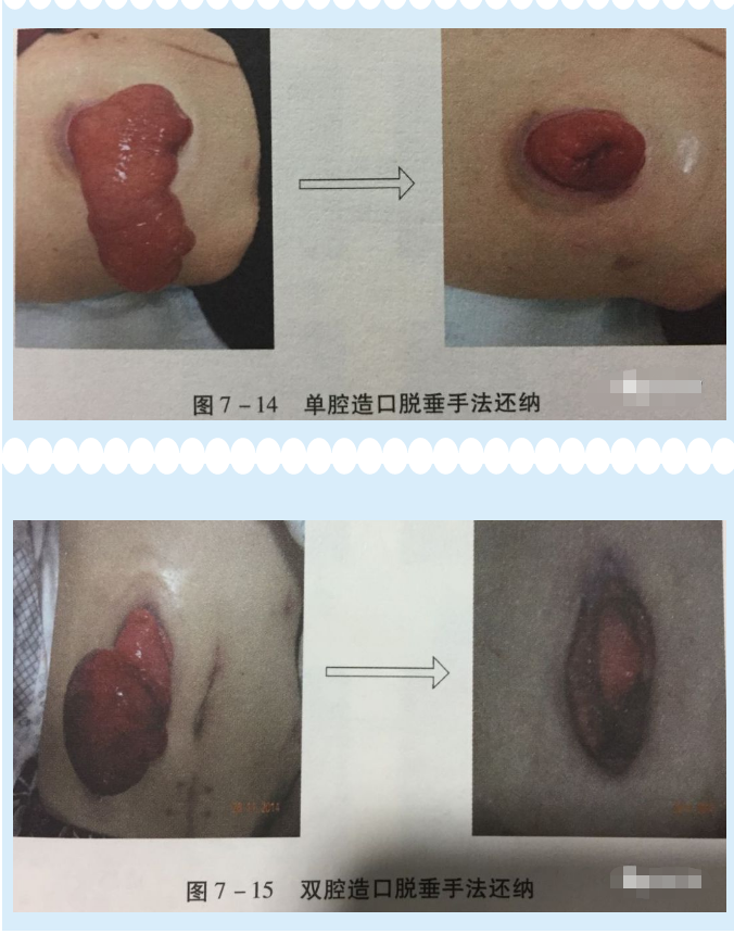 造口脱垂图片图片