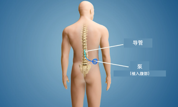 鞘内注射部位图片